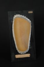 Sclérodermie en plaques (moulage décoloré, Inv. 1922)