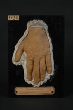 Dyshidrose de la main. Homme âgé de 27 ans