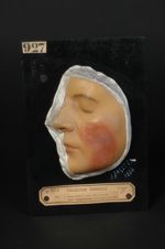 Lupus pernio (Inv. 1922). Lupus télangiectasique à marche aiguë