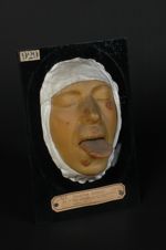 Plaques syphilitiques végétantes (Inv. 1922) de la face et de la langue. Homme âgé de 53 ans. Syphil [...]