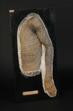 Ichtyose hyperkératosique. Homme âgé de 24 ans