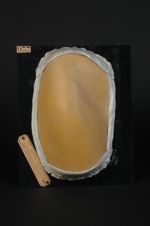 Lichen spinulosus ; peut-être aussi acné kératique de Tenneson (Inv. 1922)