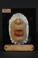 Epithéliome spino-cellulaire (Inv. 1922) de la lèvre inférieure. Homme âgé de 63 ans