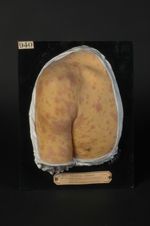 Syphilide folliculaire en corymbe, avec éléments confluents en nappe (Inv. 1922). Homme âgé de 37 an [...]