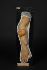 Mycosis fongoïde. Tumeurs mycosiques ; l'une d'elles présente la large ulcération classique en coupe [...]