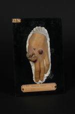 Lupus mutilant de la main. Homme âgé de 23 ans