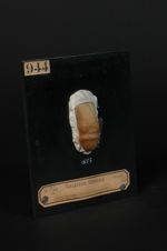 Chancre syphilitique double du prépuce. Homme âgé de 19 ans