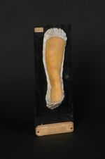 Urticaire pigmentée. Enfant âgé de 19 mois. Depuis l'âge de cinq mois, poussées incessantes d'élevur [...]