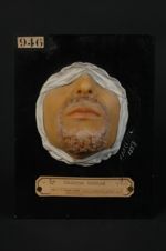 Eczéma pilaire, croûteux, à configuration orbiculaire, de la région de la barbe. Homme âgé de 33 ans