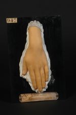 Erythème annulaire de la main. Jeune fille âgée de 13 ans