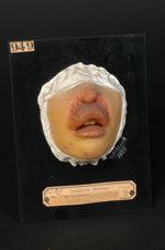 Lupus tuberculo-gommeux du nez et des lèvres. Jeune fille âgée de 18 ans (V. le n° 993, même malade  [...]