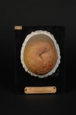 Lupus tuberculo-gommeux, développé sur un moignon de cuisse amputée pour une tuberculose du genou. J [...]