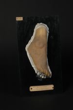 Naevus pachydermique pigmentaire. Homme âgé de 23 ans