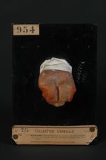 Epithéliome spino-cellulaire de la langue ; les deux tumeurs latérales sont réunies par une infiltra [...]