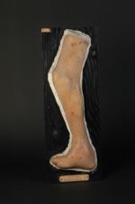 Tuberculose cutanée. Varices lymphatiques ulcérées. Lupus tuberculeux excentrique à la partie supéri [...]