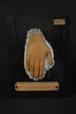 Pemphigus congénital, avec hyperonychotrophie et chute de certains ongles (Inv. 1922). Fillette âgée [...]