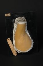 Erythrasma. Homme âgé de 68 ans