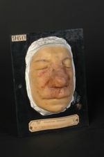 Syphilide tuberculo-gommeuse hypertrophique de la   face. Homme âgé de 52 ans