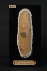 Leishmaniose cutanée (Inv. 1922). Bouton de Biskra. Homme âgé de 40 ans