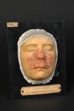 Lupus tuberculeux en groupe du centre de la face