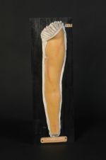 Dermatose en bande du membre supérieur (Inv. 1922). Lésion indéterminée