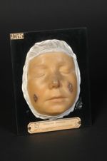 Lupus tuberculo-gommeux de la joue. Femme âgée de 20 ans