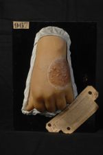 Kérion de Celse. Folliculite agminée trichophytique. Homme âgé de 25 ans, porteur de pianos