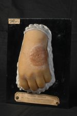 Kérion de Celse. Folliculite agminée trichophytique. Homme âgé de 25 ans, porteur de pianos