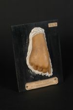 Verrues planes, passant au stade de verrues papillaires (Inv. 1922). Homme âgé de 20 ans. Verrues