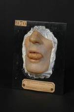 Ulcération tuberculeuse de la langue. Homme âgé de 49 ans