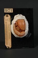 Épithéliome spino-cellulaire sublingual ayant envahi la langue (Inv. 1922). Homme âgé de 49 ans. — L [...]
