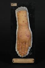 Erythème polymorphe, forme papuleuse hémorragique