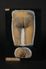 Naevus verruqueux systématisé de la région génitale et de la face postérieure des cuisses. Garçon âg [...]