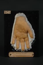 Dyshidrose. Homme âgé de 20 ans