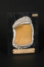 Sclérodermie en plaques ; morphée du cou