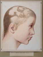 [Alopécie syphilitique ?]