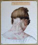 Psoriasis