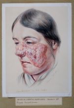 Lupus herpétiforme