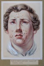 Impetigo sparsa