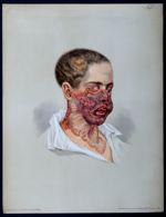 Lupus serpiginosus hypertrophicus - Atlas der Hautkrankheiten