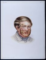 Eczema impétiginosum faciei. Porrigo larvalis Willan - Atlas der Hautkrankheiten