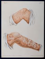 Fig. 1 : Prurigo simplex mihi seu formicans Willani / Fig.  2  : Prurigo agria mihi. Impetigo scabid [...]