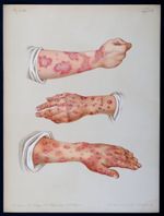 Fig . 1  : Erythema annulare seu marginatum / Fig. 2  : Erythema iris / Fig. 3 : Erytema papulatum.  [...]