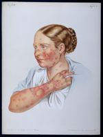 Erythema et herpes iris, annulare seu circinatum - Atlas der Hautkrankheiten