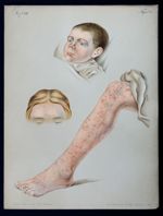 Fig. 1 : Milum seu grutem / Fig. 2 : Acne ex iodo. Fig. 3 : Acne e pice - Atlas der Hautkrankheiten