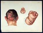 Fig. 1 : Sycosis framboesiformis / Fig. 2 : Rhinoscleroma / Fig. 3 : Framboesia - Atlas der Hautkran [...]