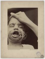 Hôpital Saint-Louis, service du Docteur Thibierge [recto] - Syphilis héréditaire, dents, Patient : e [...]