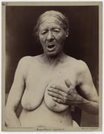 Hôpital Saint-Louis, service du Docteur Hallopeau. Acanthosis nigricans [recto] - Végétations papill [...]