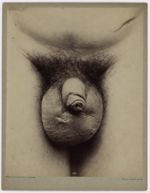 Hôpital Saint-Louis, service du  Professeur  Fournier [recto] - Syphilis, lymphangite du scrotum[ver [...]