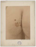 Hôpital Saint-Louis, service de M. le Docteur Thibierge [recto]- Xanthame juvénile familial (fesse)  [...]